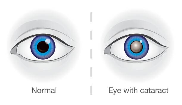Cataract in Human eye