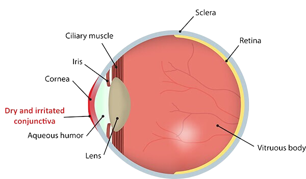 dry-eye