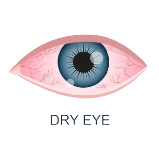 dry eye