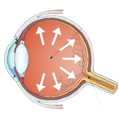 glaucoma eye