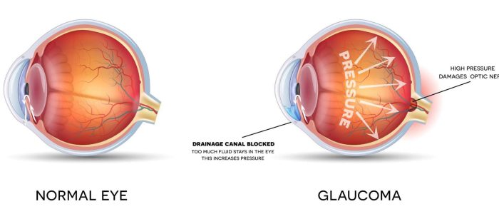 glaucoma